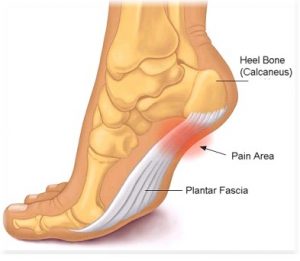 plantar fasciitis