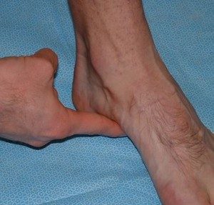 Supination Resistance
